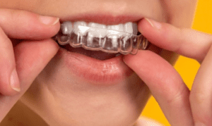 La importancia de los retenedores en la ortodoncia