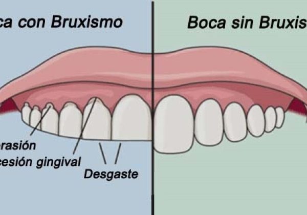 bruxismo y estrés